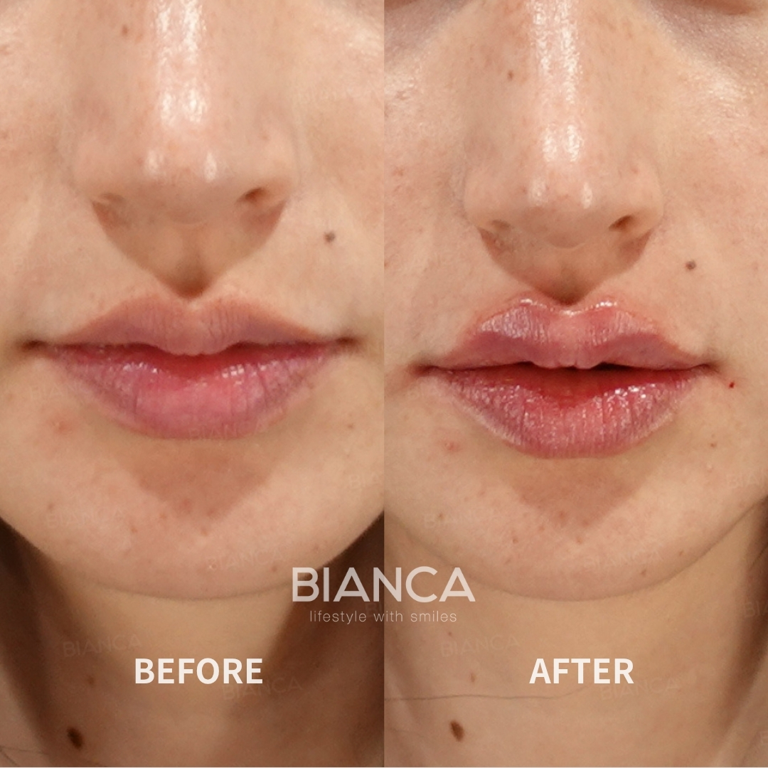 Hyaluronic Acid Injection For Lips