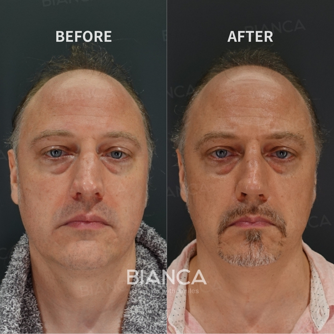 Nasal Tip Reduction Surgery  / Hump Reduction Surgery (Dorsal Hump Removal / Hump Shaving)  / Nasal Bone Osteotomy (Medialization Osteotomy) / Nasal Tip Formation/Reduction – Columella Strut Method