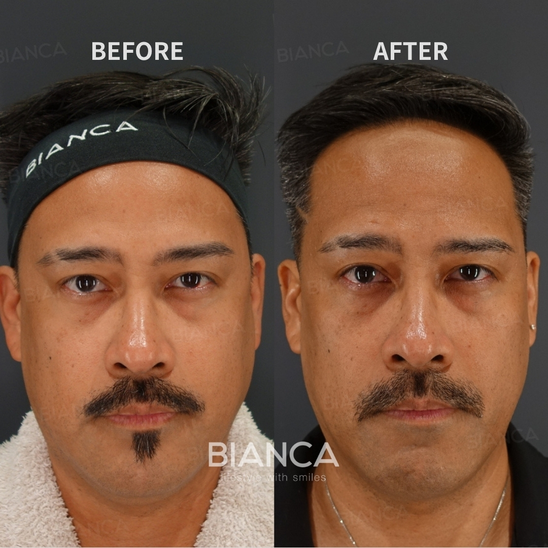 Morpheus8 / EmbraceRF【FACE】/ Under chin Liposuction