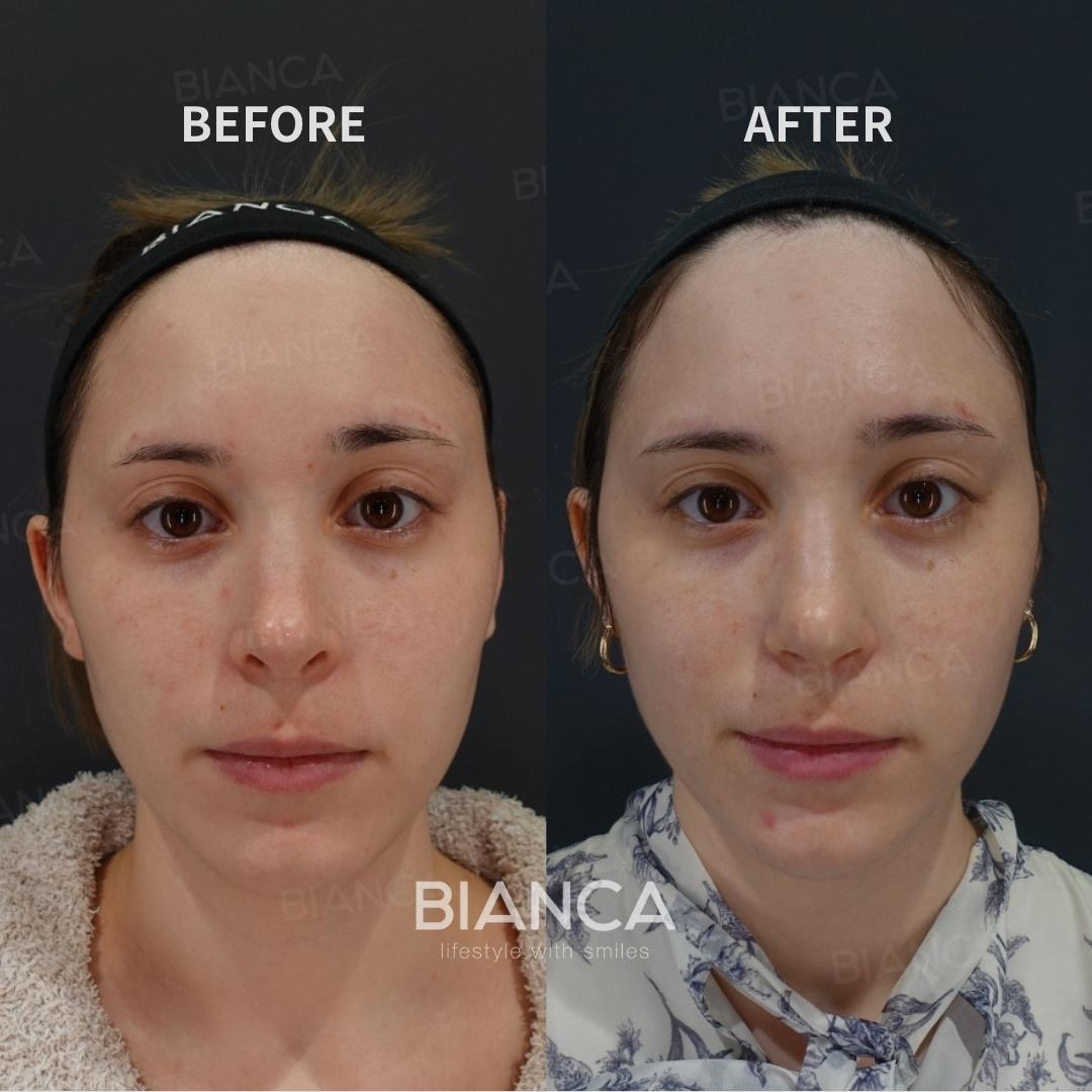 Nasal bone osteotomy、Nasal tip shaping 、Rhinoplasty <reduction of the nostril rim sizes=