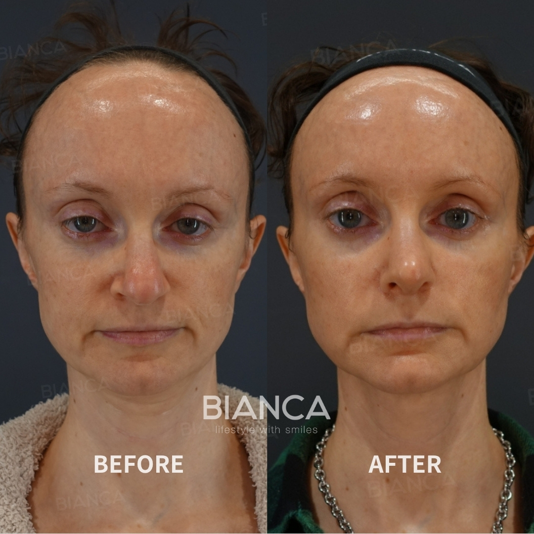 Nasal tip shaping、Nasal tip cartilage graft、Rhinoplasty <Nasal Tip Formation/Reduction - Columella Strut Method、Nasal tip reduction 、BIANCA LIFT