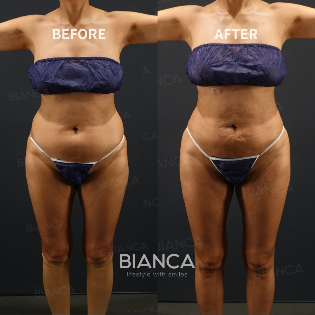 Butt Augmentation (Brazilian Butt Lift)