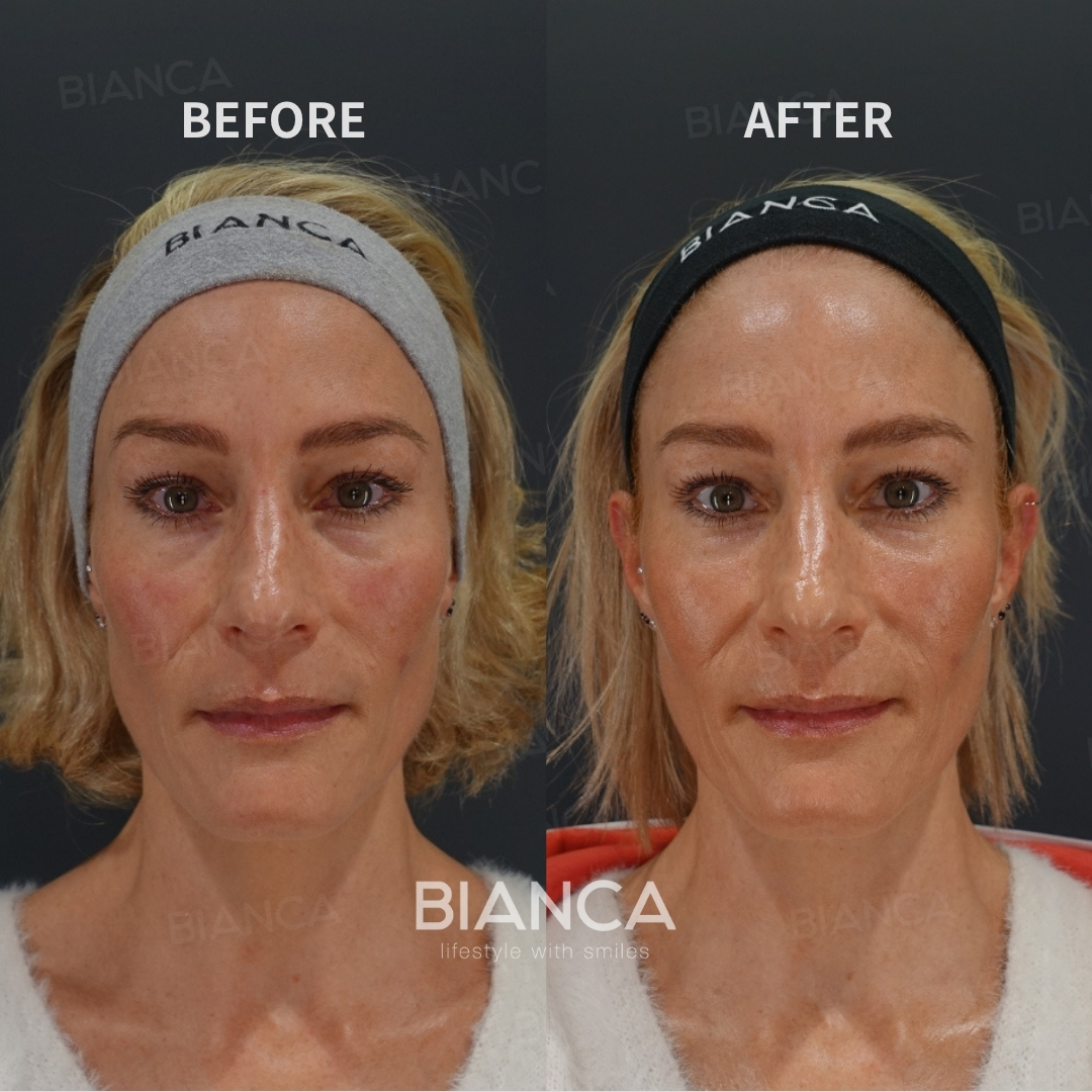 Baby Collagen Injection for Under-Eye Dark Circles