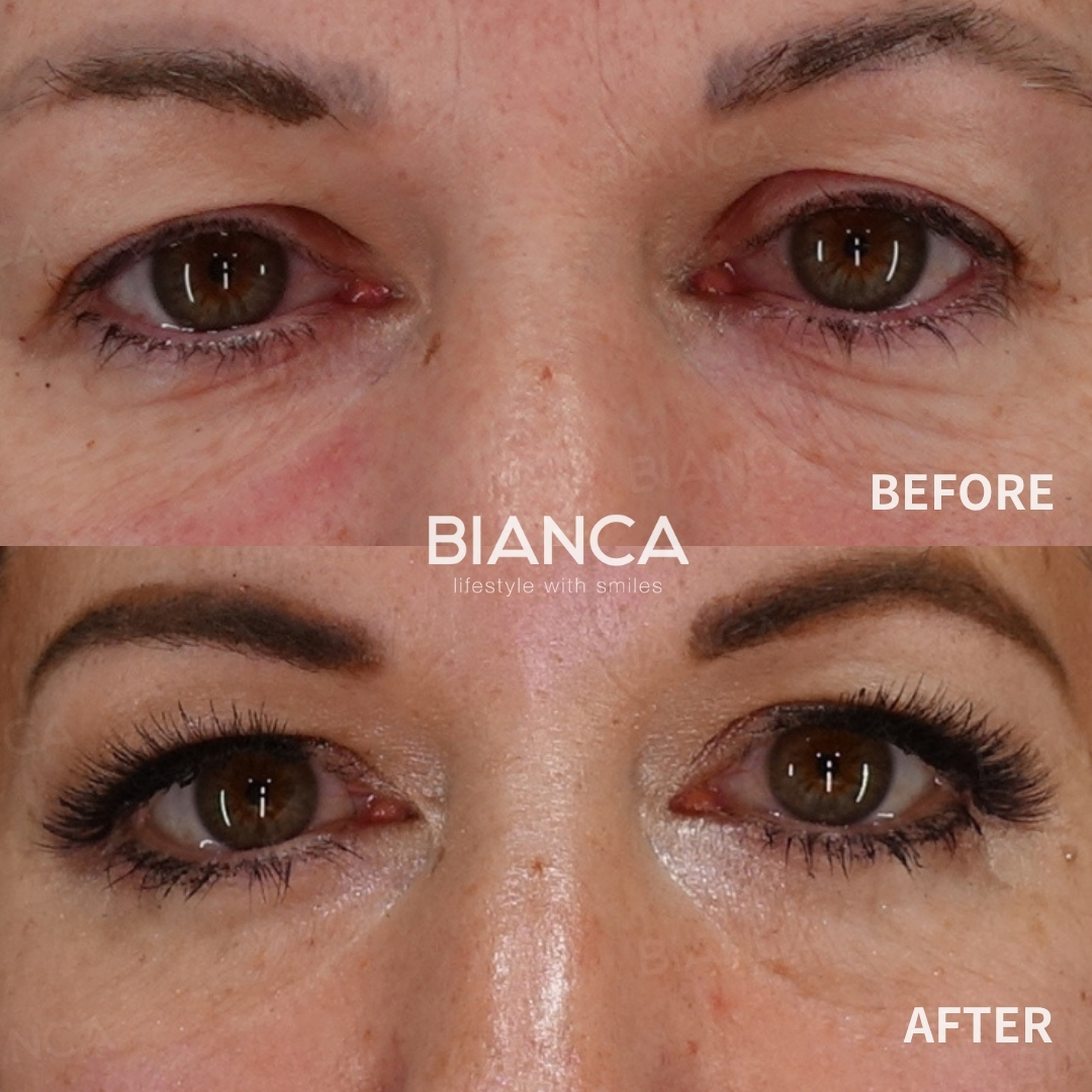 Lower eyelid ptosis correction