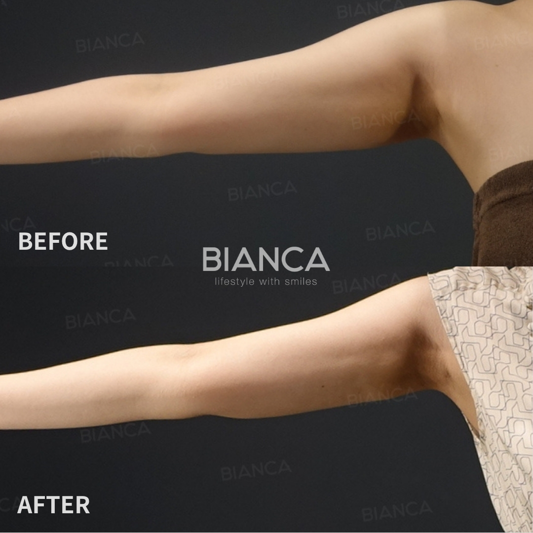 VASER Liposuction ( Upper Arm)