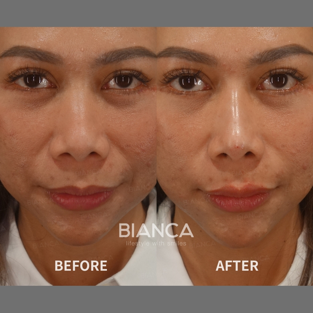 Hyaluronic Acid Injection For Nose and Lips