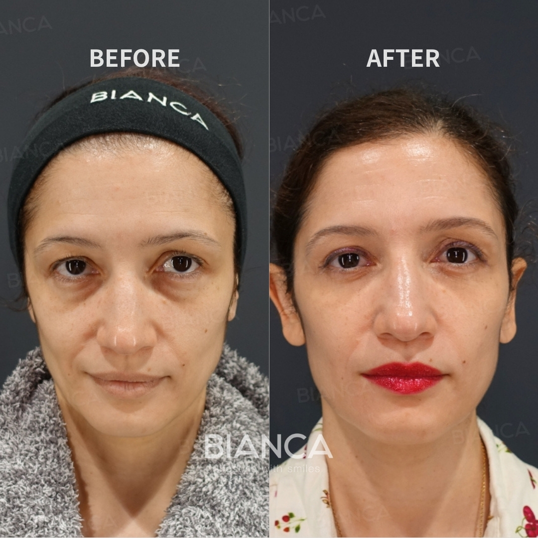 The Hamra Method / Upper Blepharoplasty