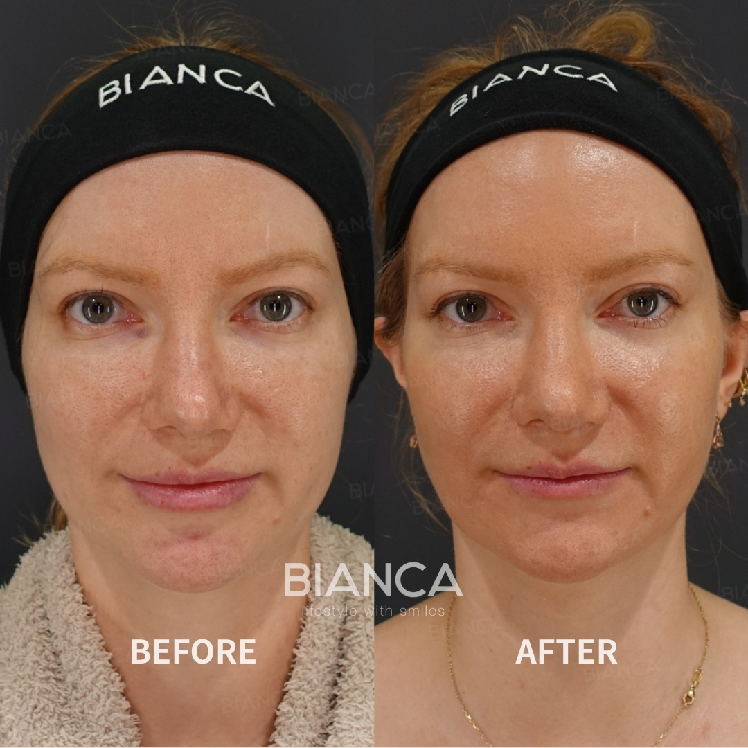 Morpheus8 【Submandibular】/ EmbraceRF【FACE】/ Lipo Suction 【Submandibular】