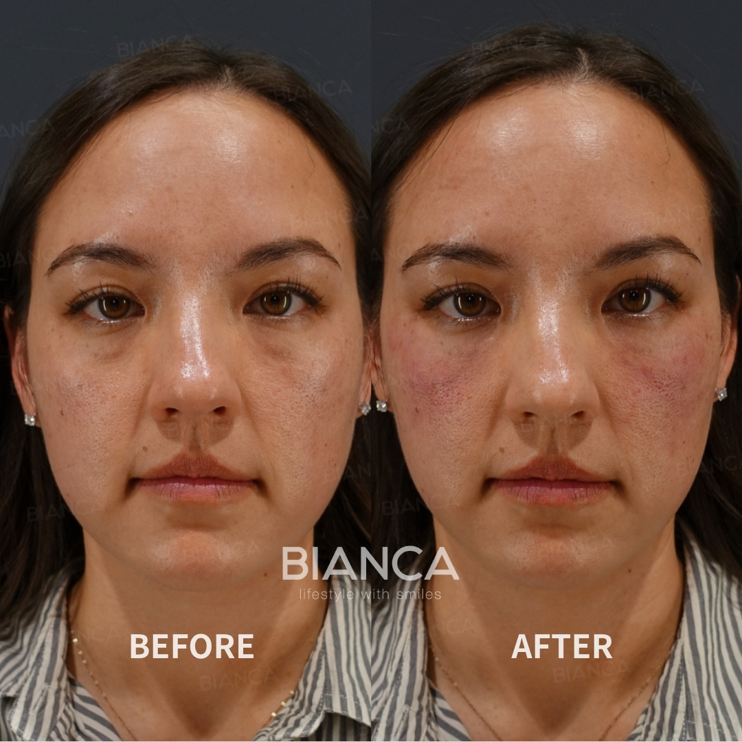 Baby Collagen Injection for Under-Eye Dark Circles