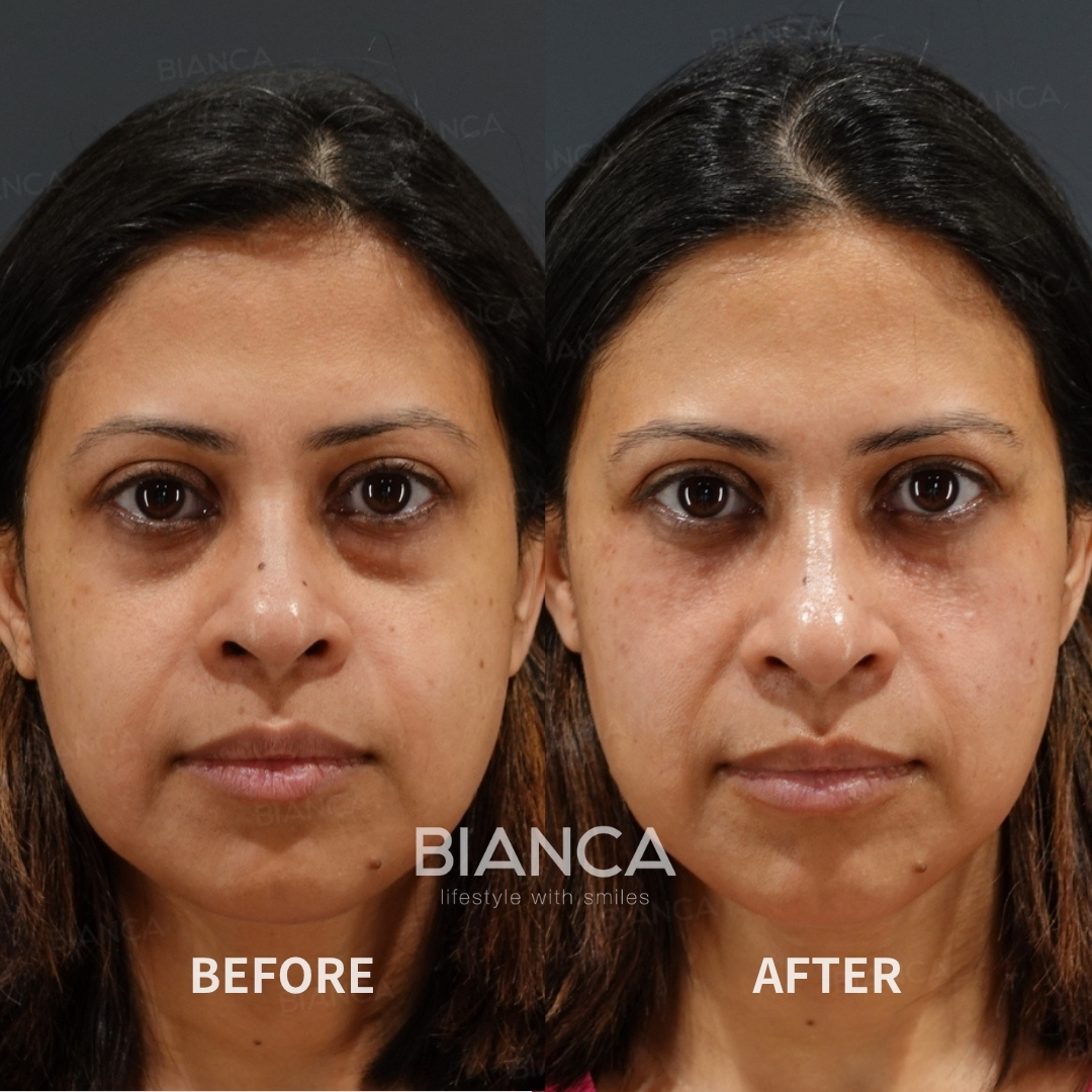 Baby Collagen + Hyaluronic Acid Injection for Under-Eye Dark Circles