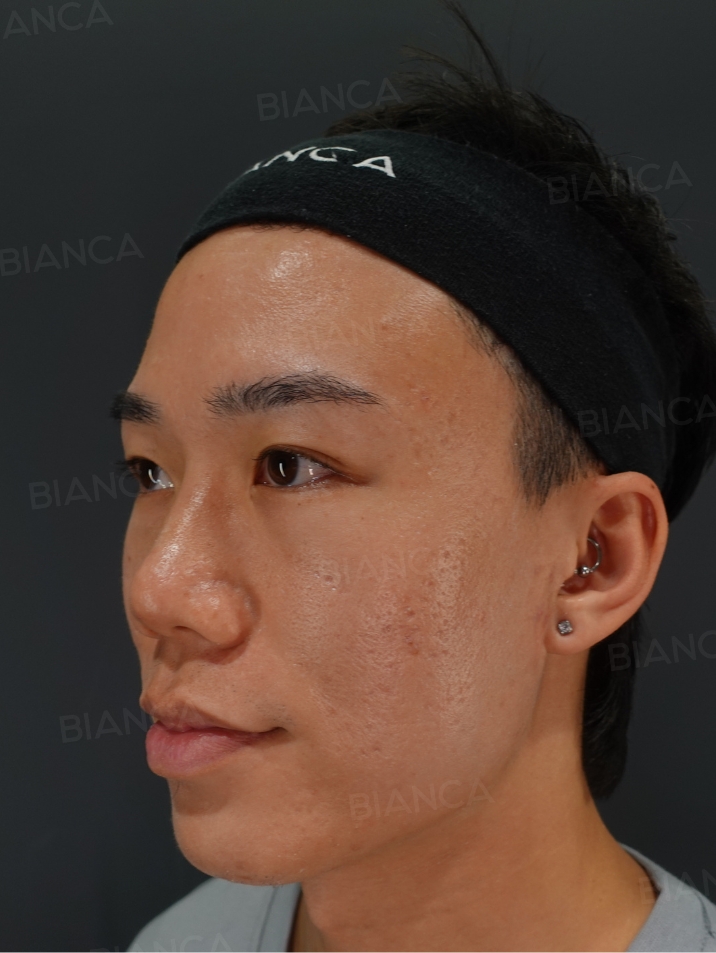 45-degree View Before