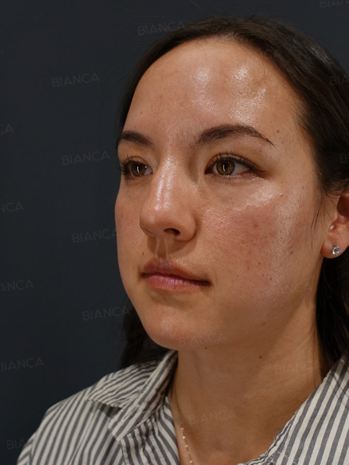 45-degree View Before