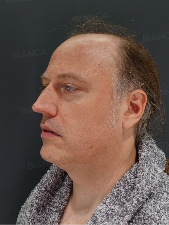 45-degree View Before