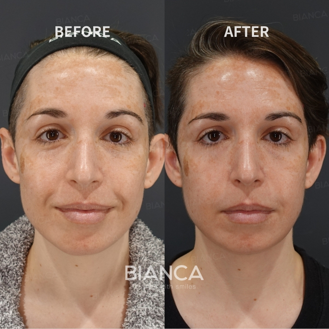 Morpheus8 【Submandibular】/ EmbraceRF【FACE】/ Liposuction 【Submandibular】