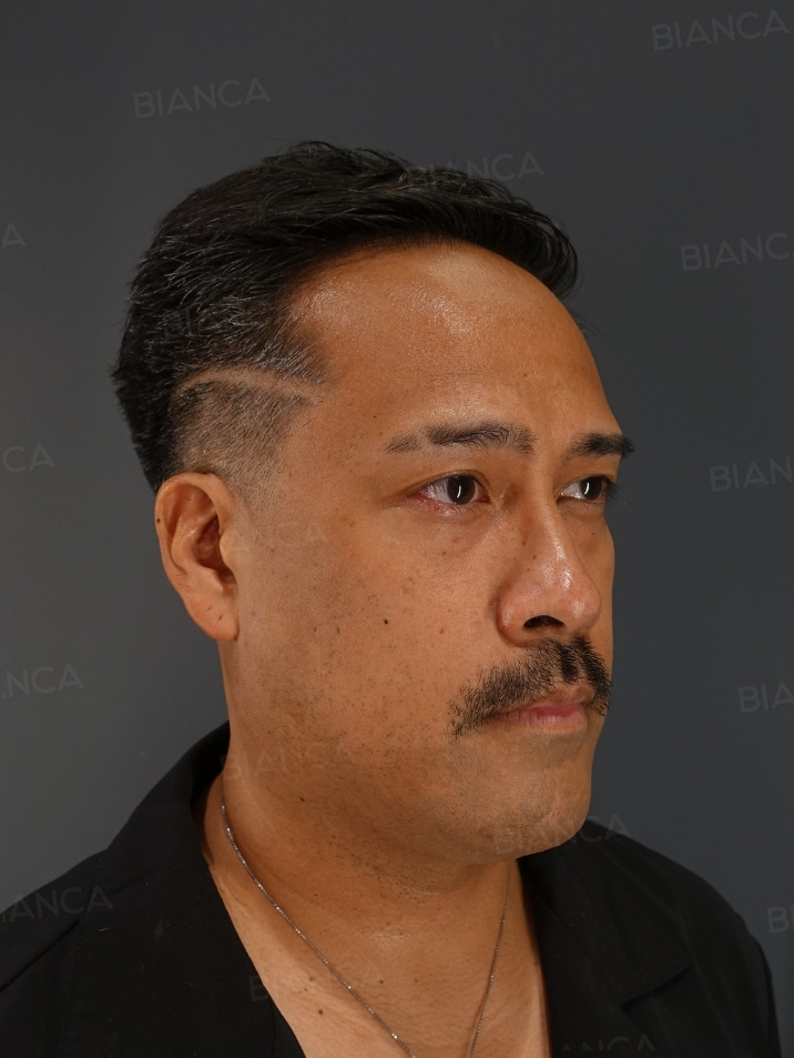 45-degree View After