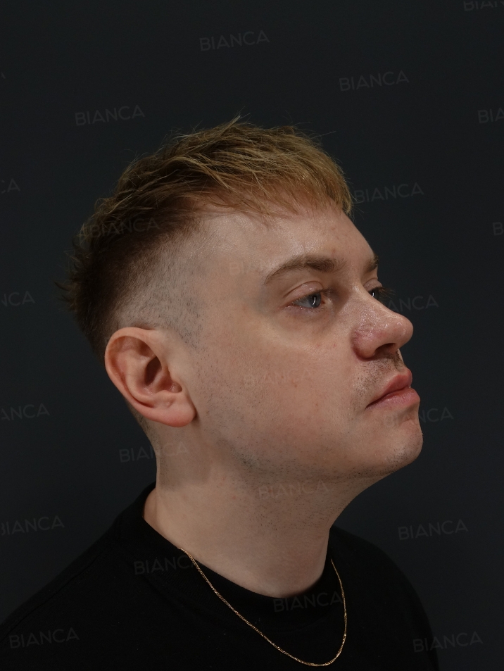 45-degree View After