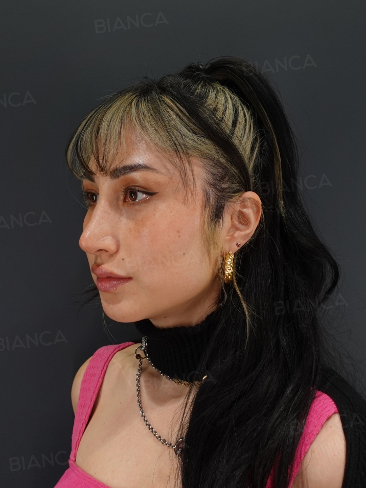 45-degree View After