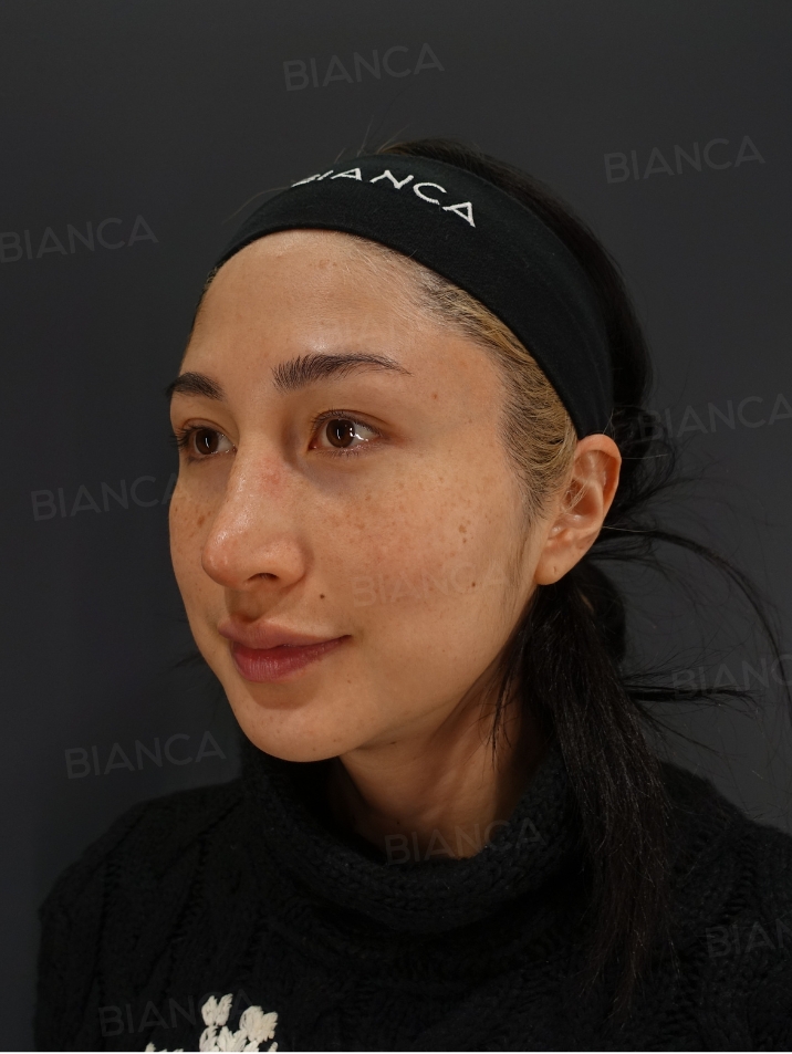 45-degree View After