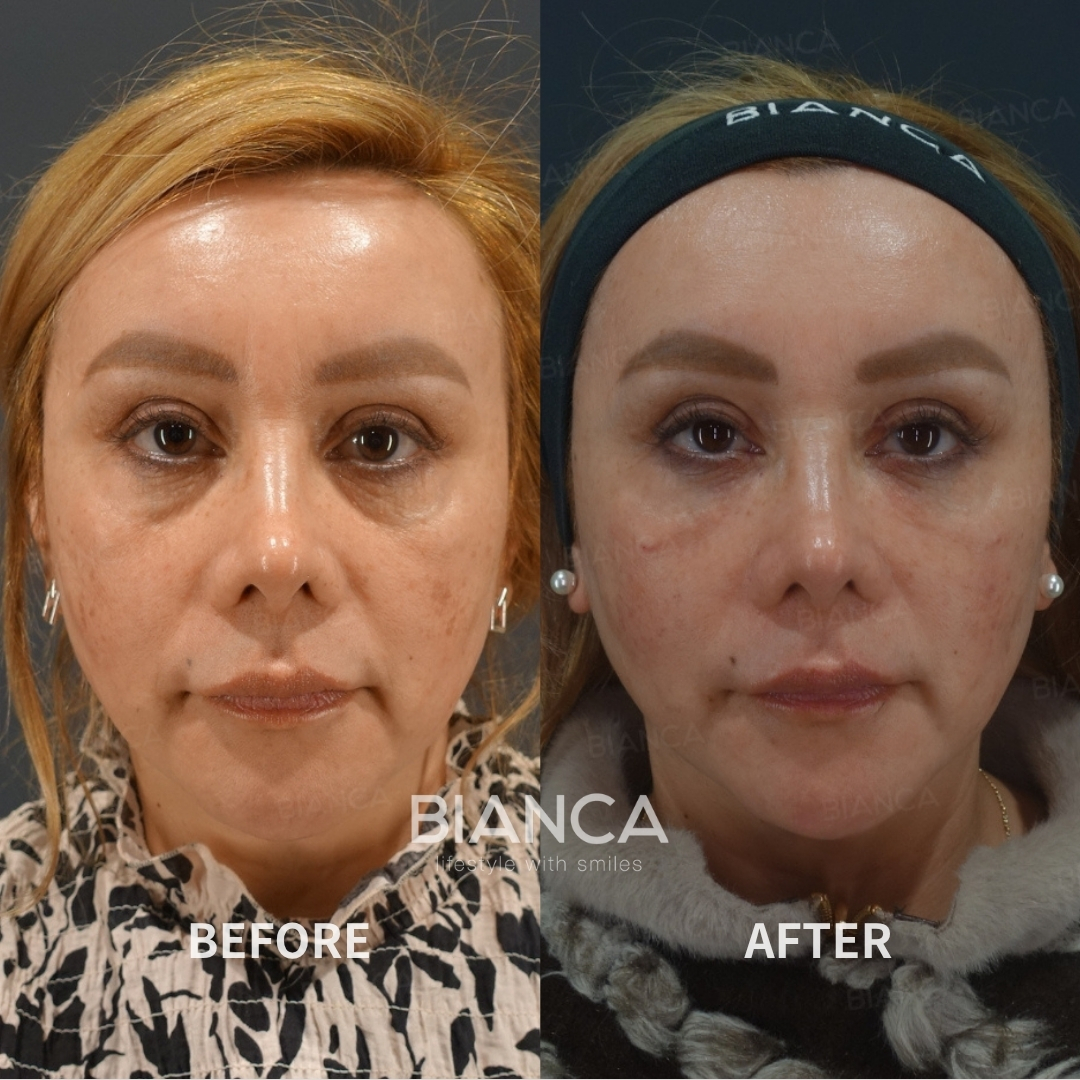 Baby Collagen Injection for Under-Eye Dark Circles