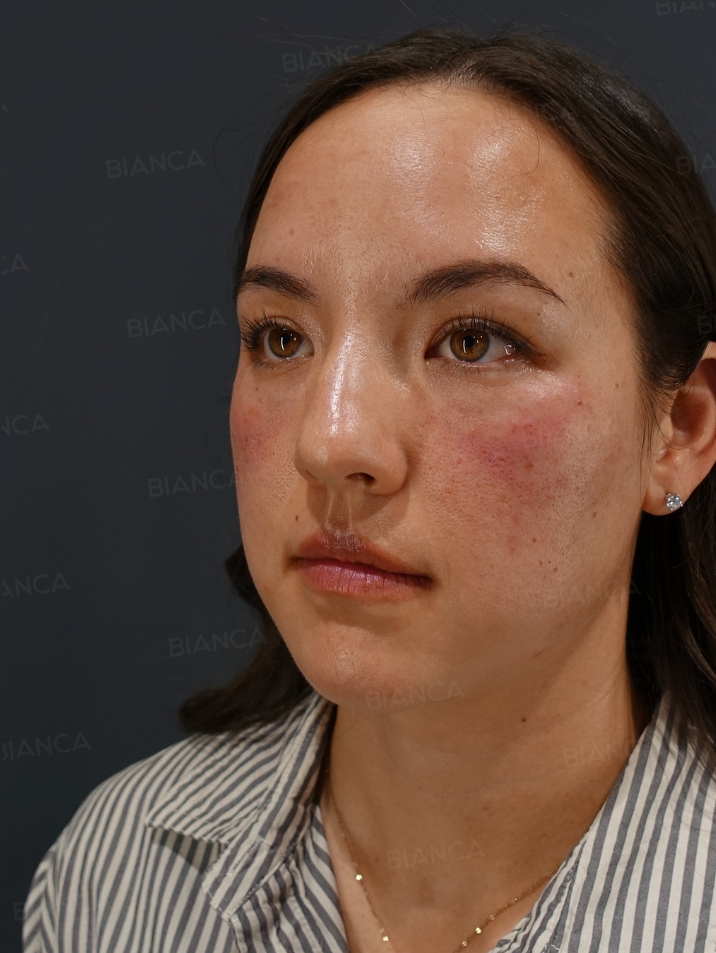 45-degree View After