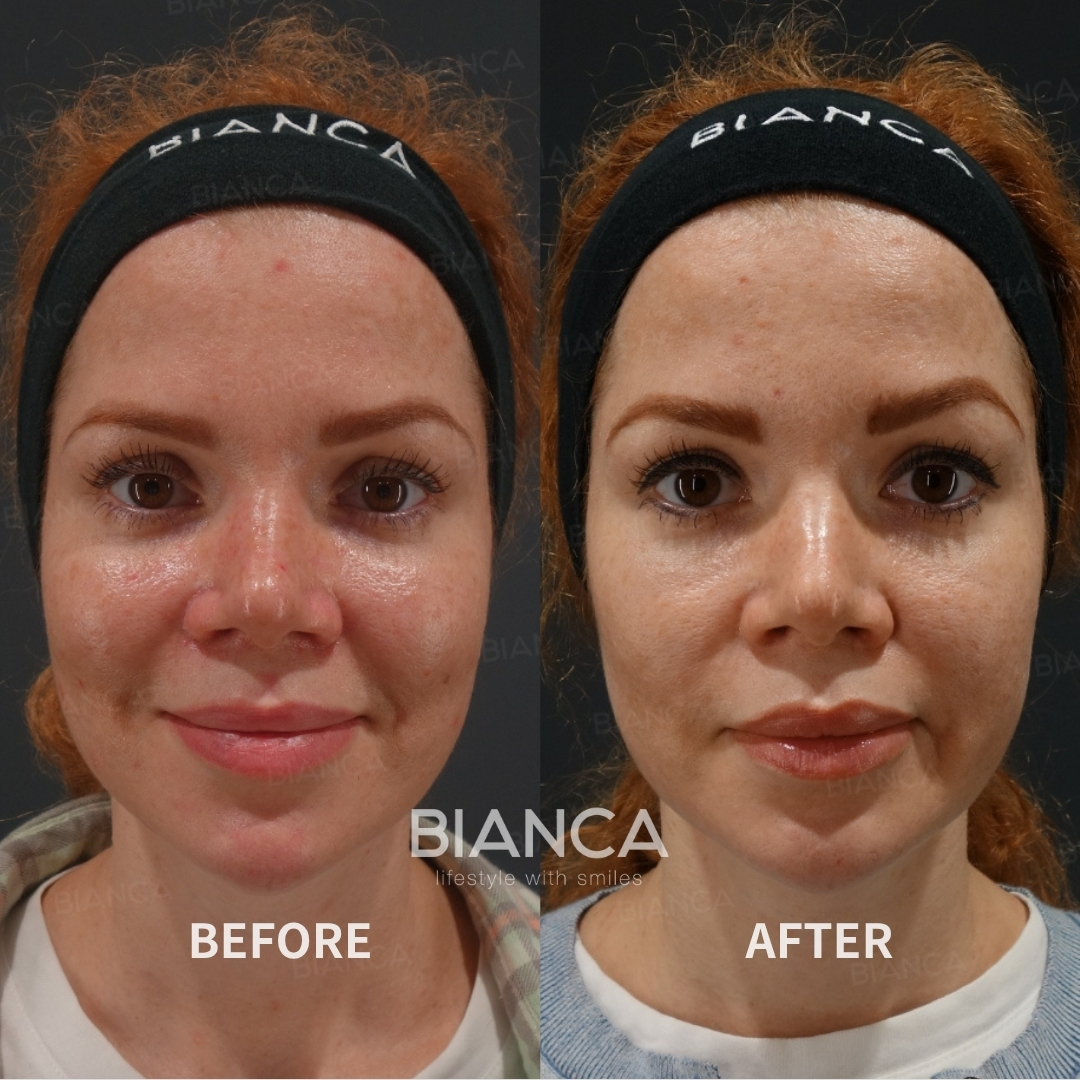 Pico Spot  Unlimited Full Face