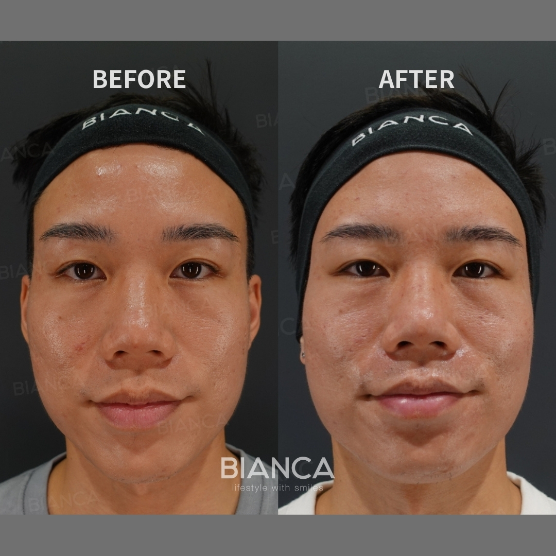 POTENZA Rejuran for Full Face