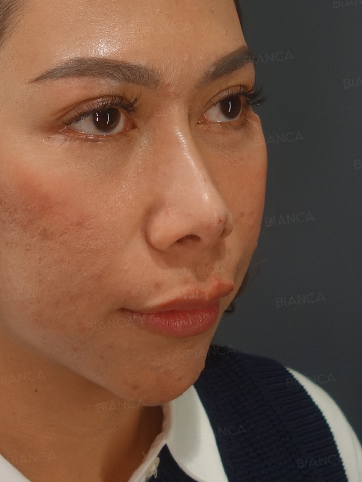 45-degree View After