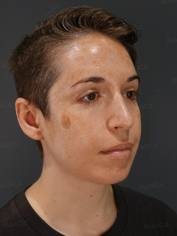 45-degree View After