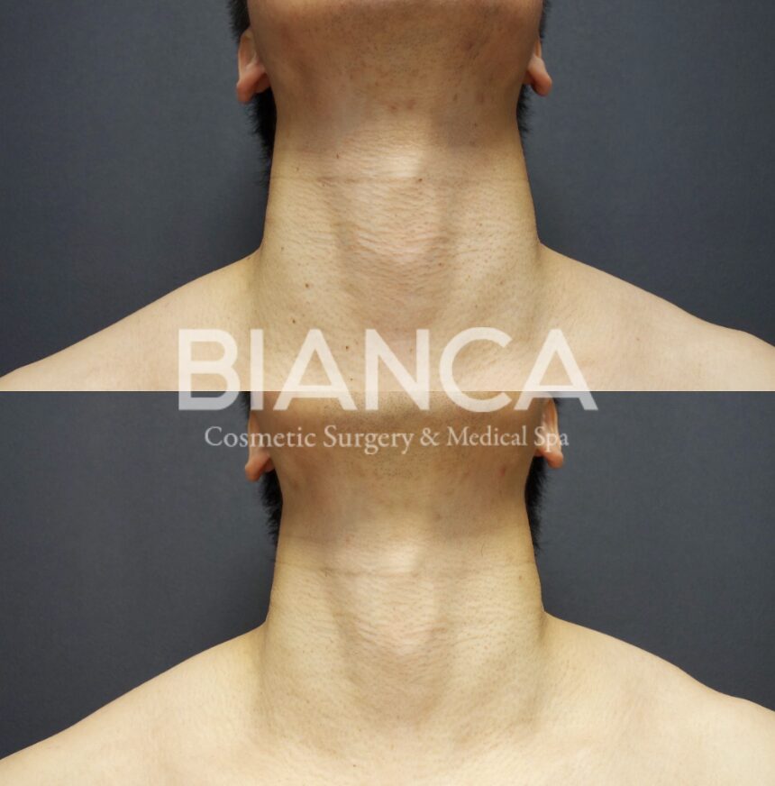 Rediscover Clear Skin: Your Premier Guide to Professional Wart Removal in Japan at BIANCA CLINIC Ginza