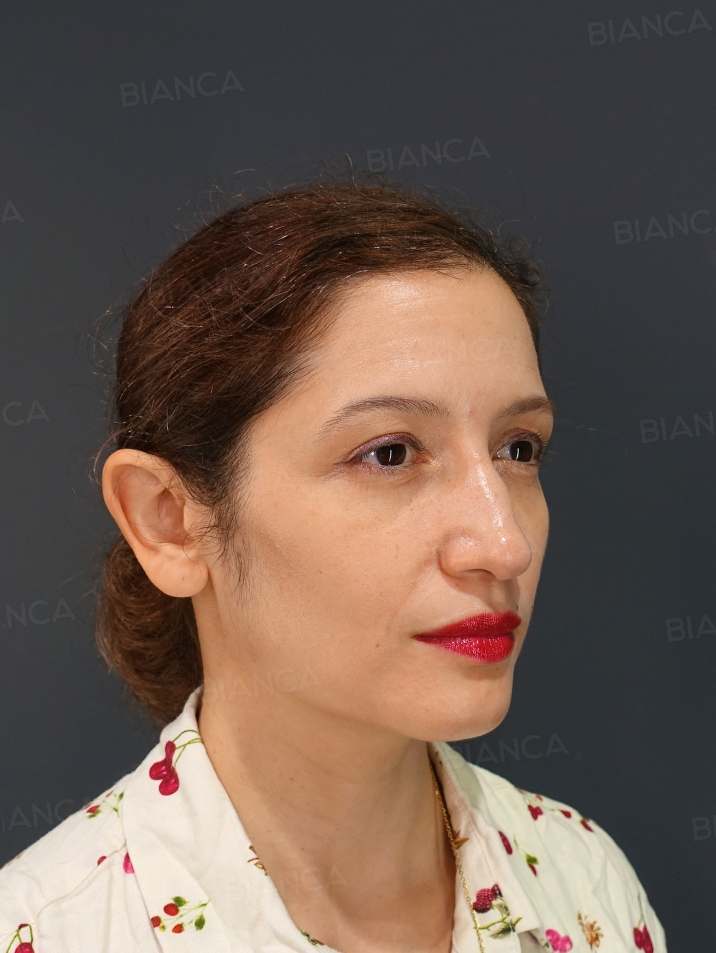 45-degree View After