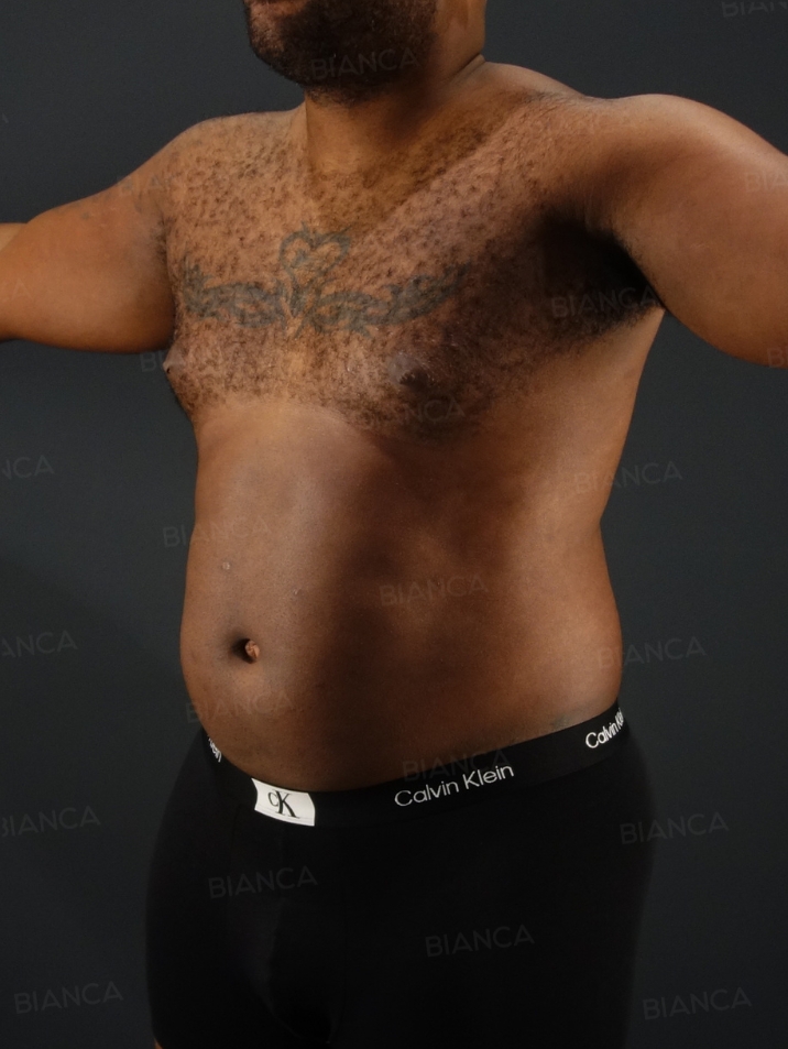 45-degree View Before