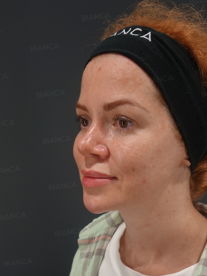 45-degree View Before