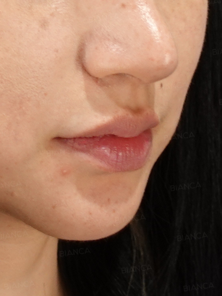 45-degree View Before