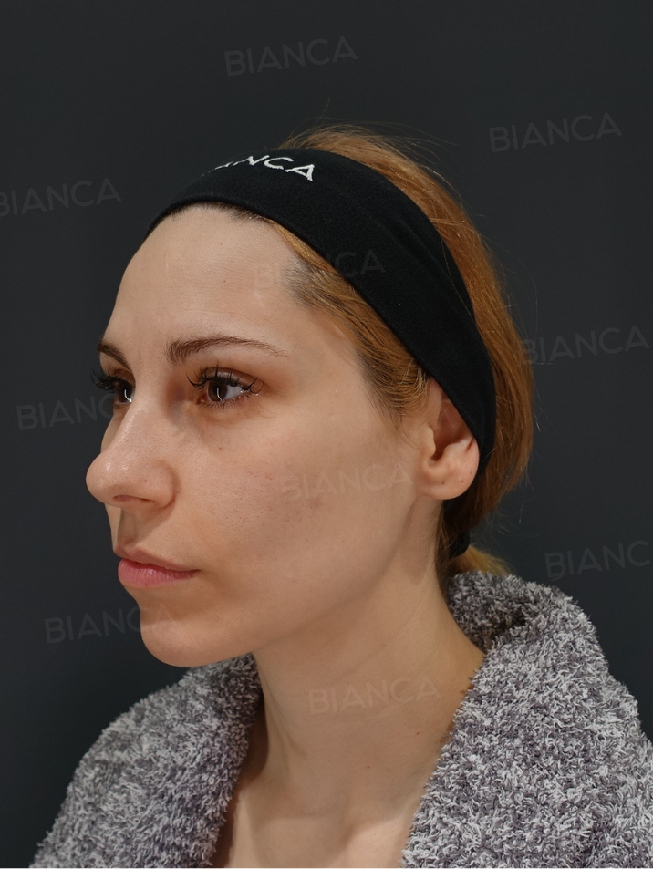 45-degree View After