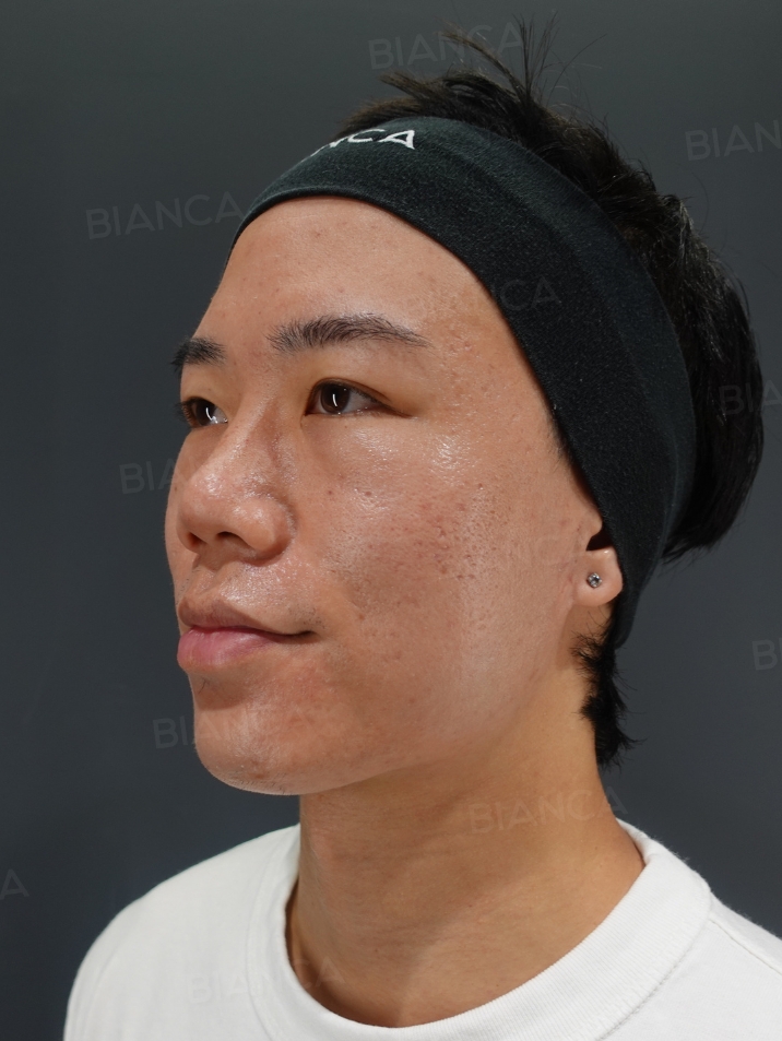 45-degree View After