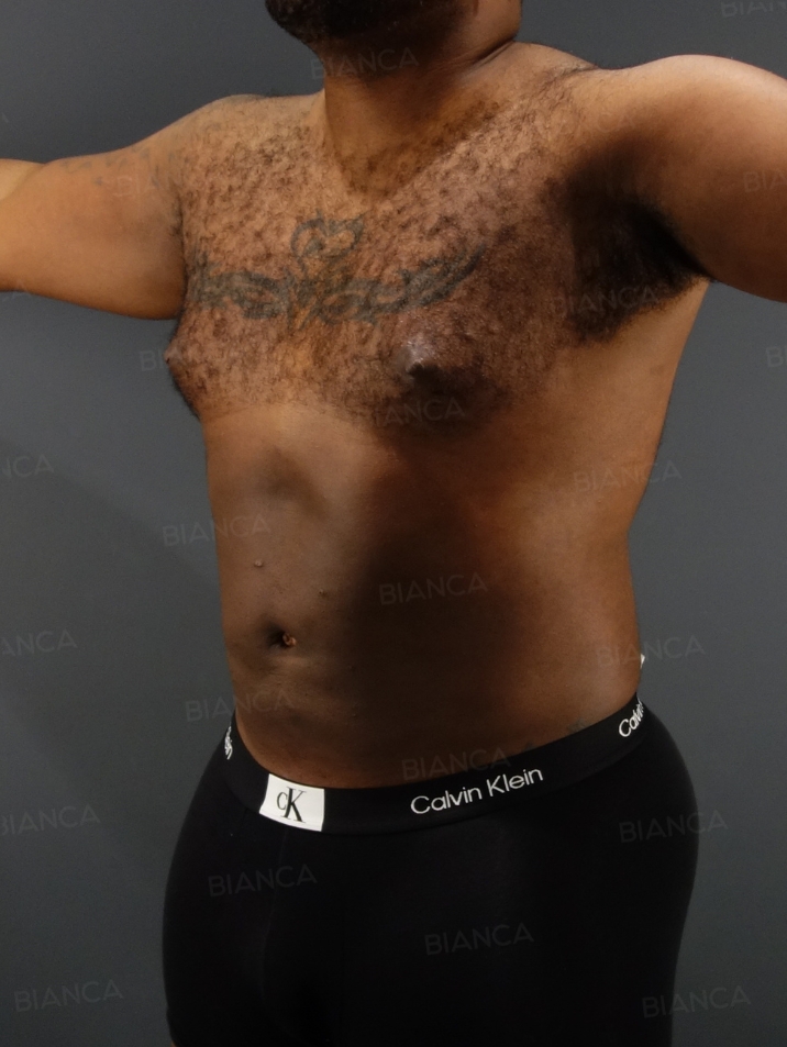 45-degree View After