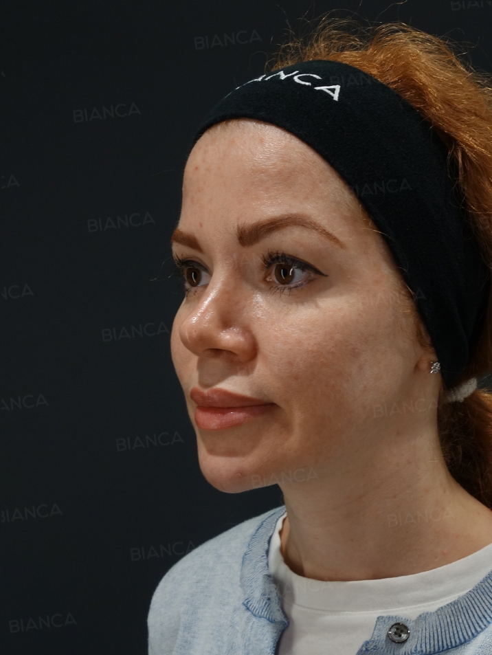 45-degree View After