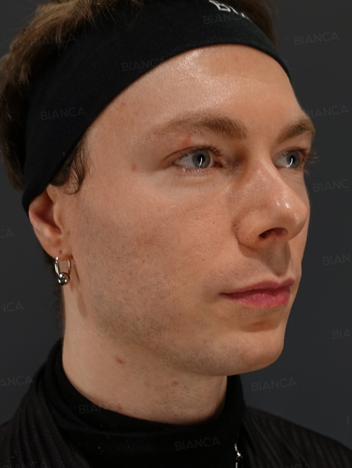 45-degree View After