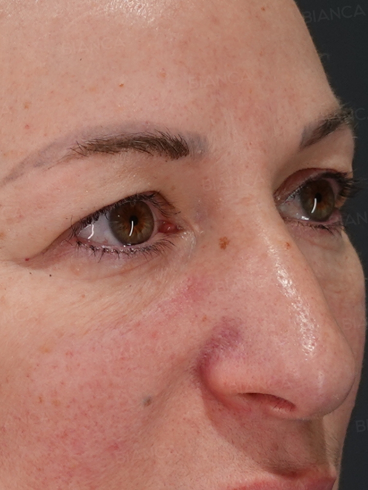 45-degree View Before