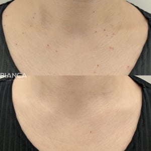 Professional Wart Removal in Japan at BIANCA CLINIC <br>Dr. Iwama