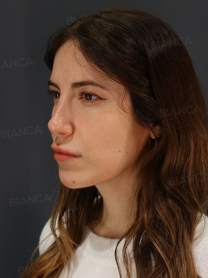 45-degree View Before