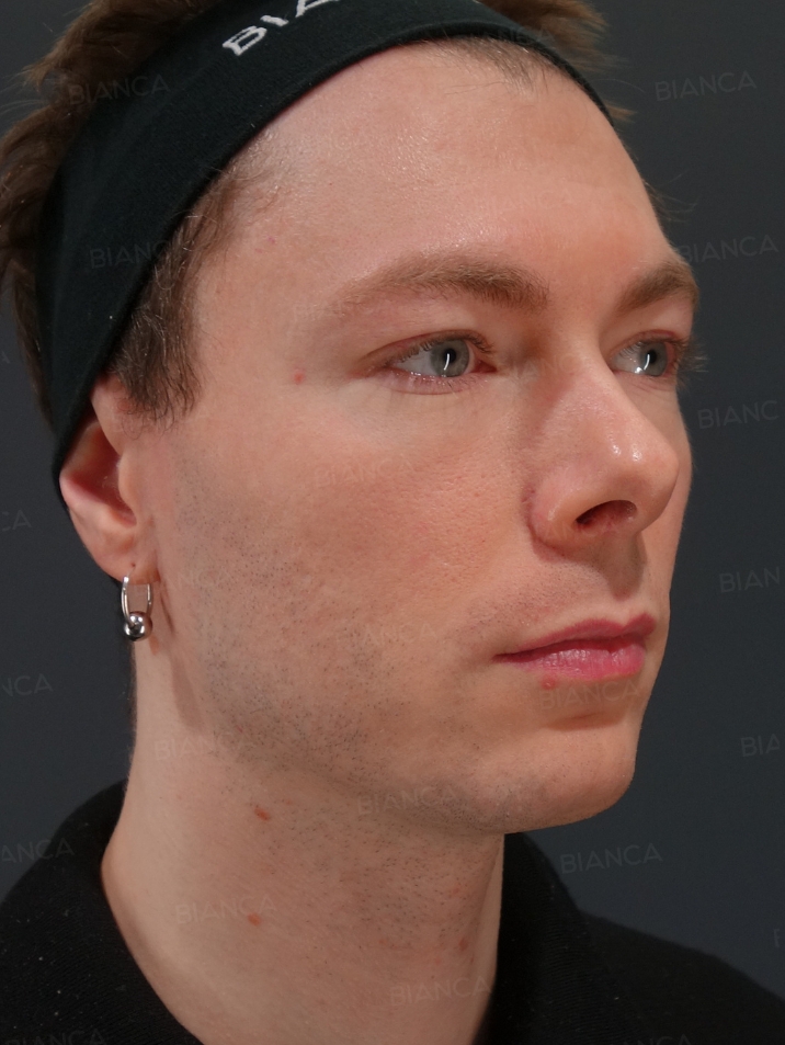 45-degree View Before