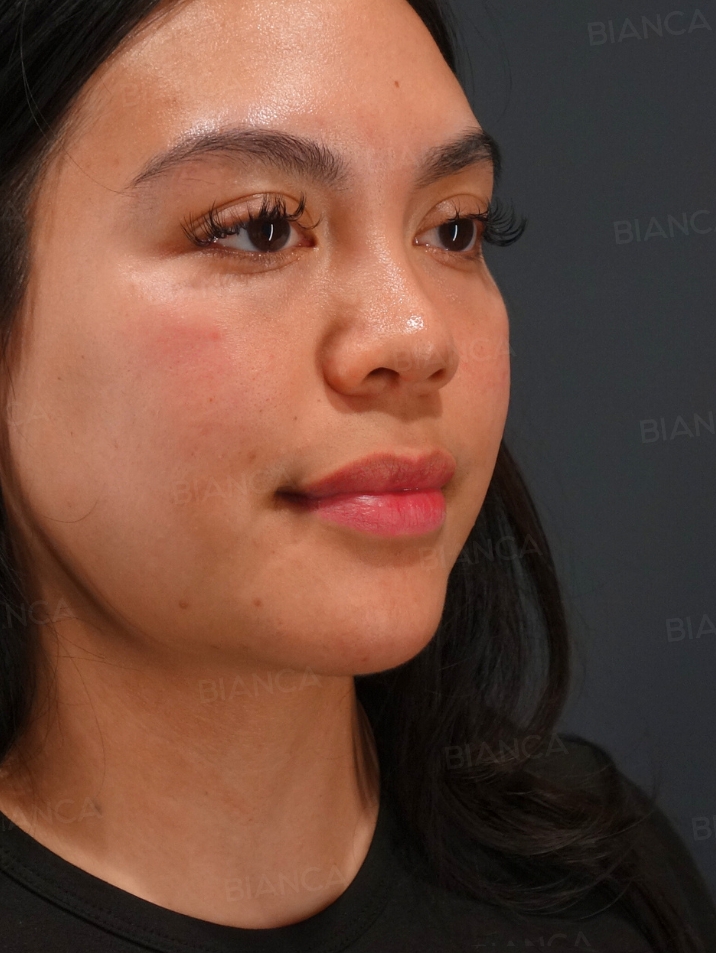 45-degree View Before