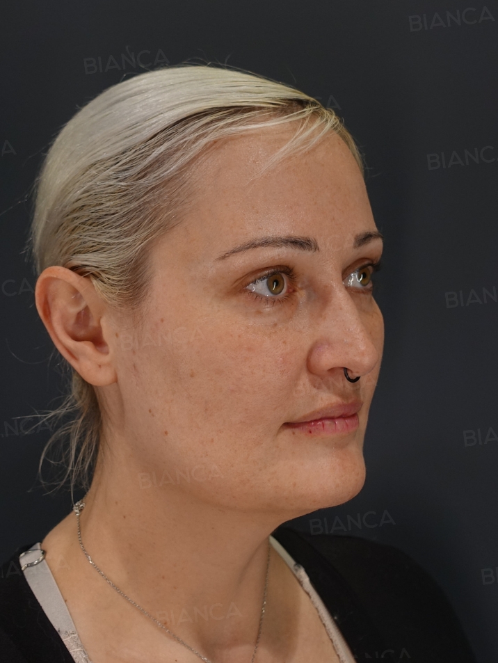 45-degree View After