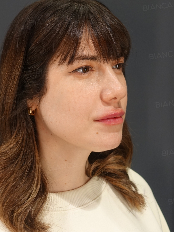 45-degree View After