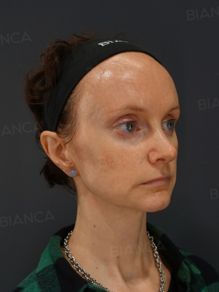 45-degree View After