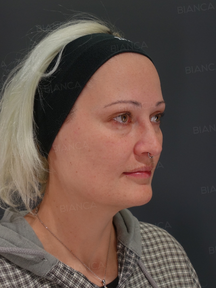 45-degree View Before