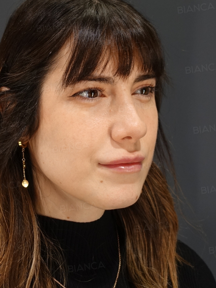 45-degree View Before