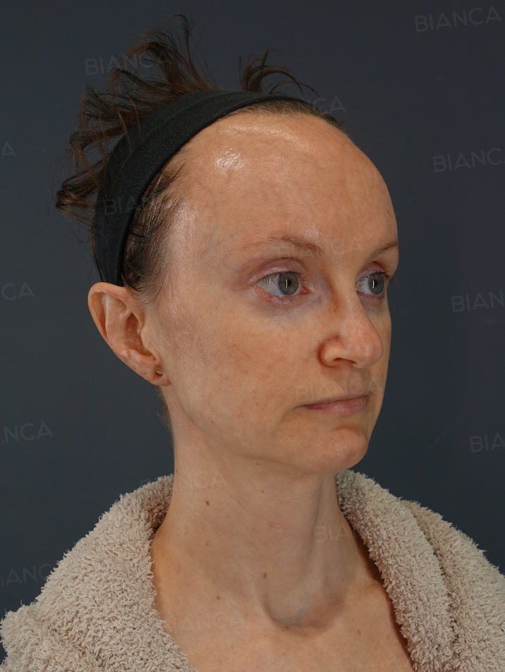 45-degree View Before