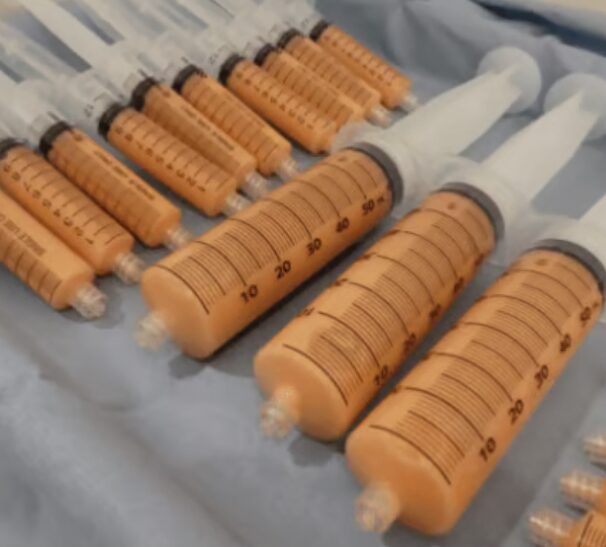 Achieve a youthful appearance with your own fat, purified of impurities (Condensed Rich Fat)